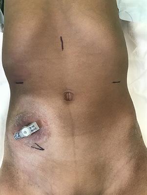 Robotic Approach to Creation of Continent Catheterisable Channels—Technical Steps, Current Status, and Review of Outcomes